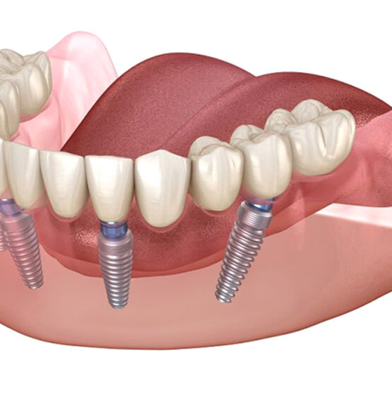 illustration of All0On-4 dental implants for lower dental arch