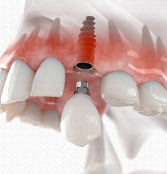 illustration of traditional dental implant between natural teeth