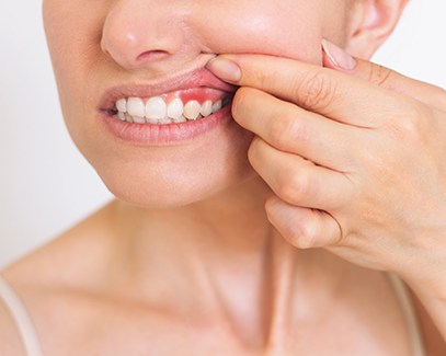 Woman pulling up her lip to reveal red, swollen gums