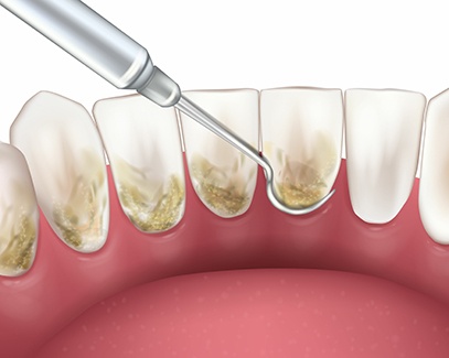 Illustration of instrument being used to scale teeth