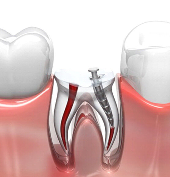 a 3D illustration of a root canal