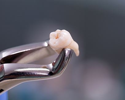 Dental forceps holding an extracted tooth