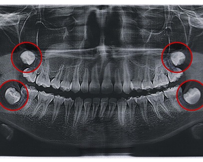 A dental X-ray that highlights a patient’s wisdom teeth