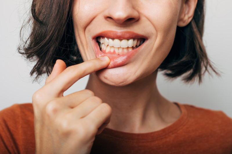 Patient showing gums after scaling and root planing